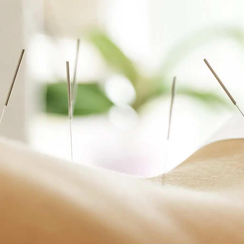 acupuncture needles on back