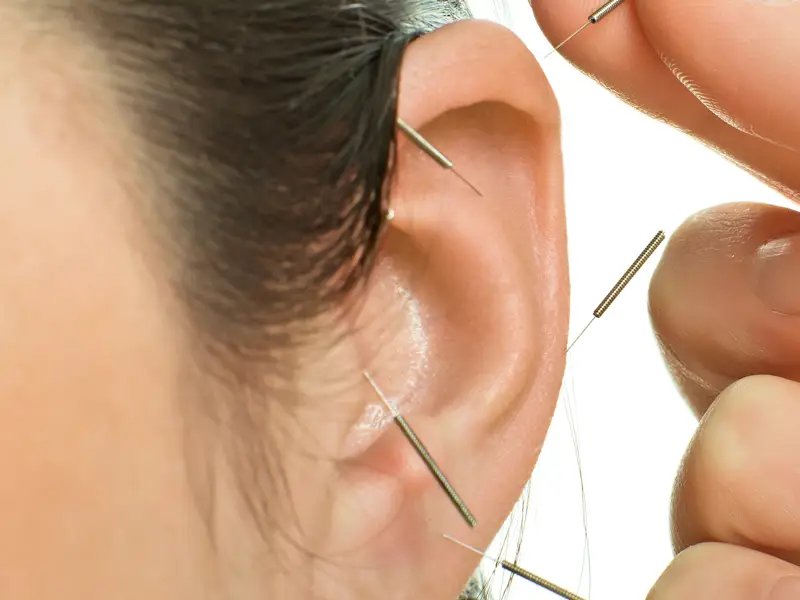 auricular acupuncture