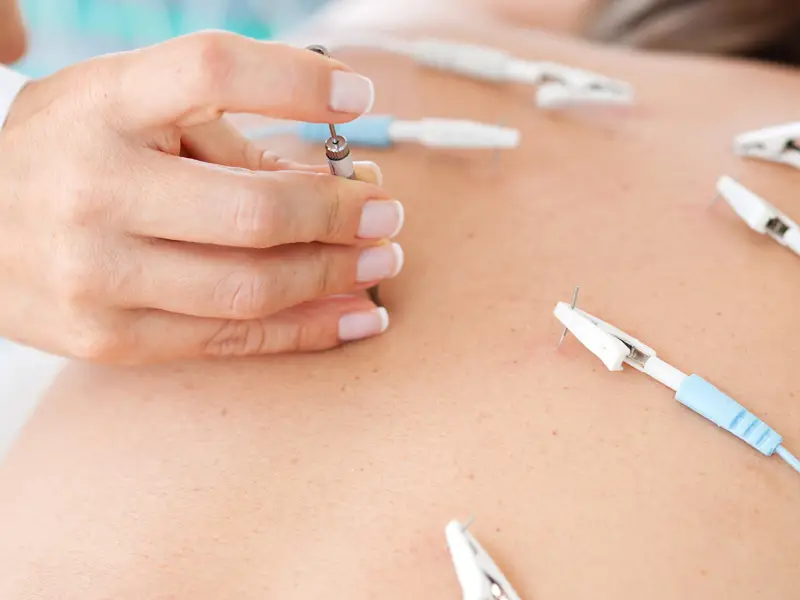 electroacupuncture