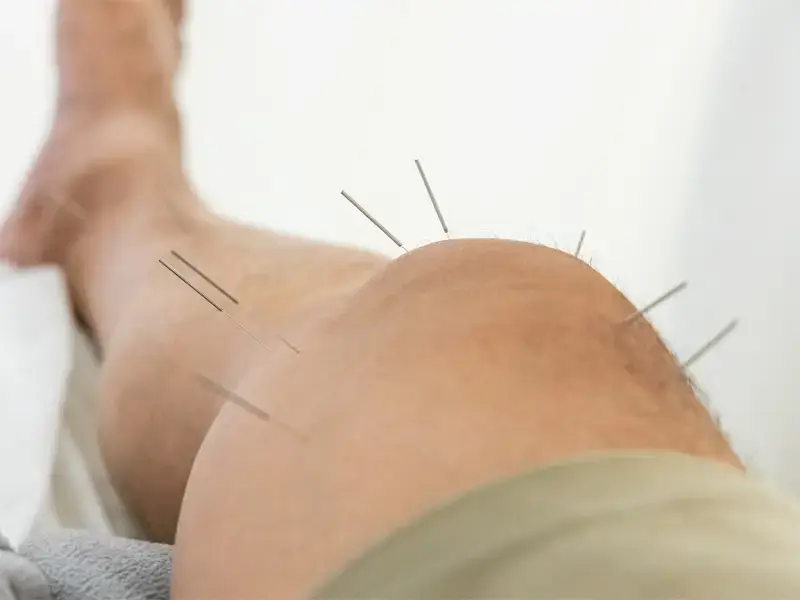 traditional acupuncture