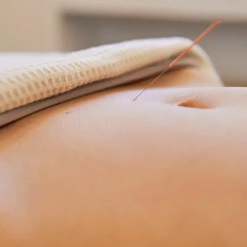 acupuncture fertility treatment