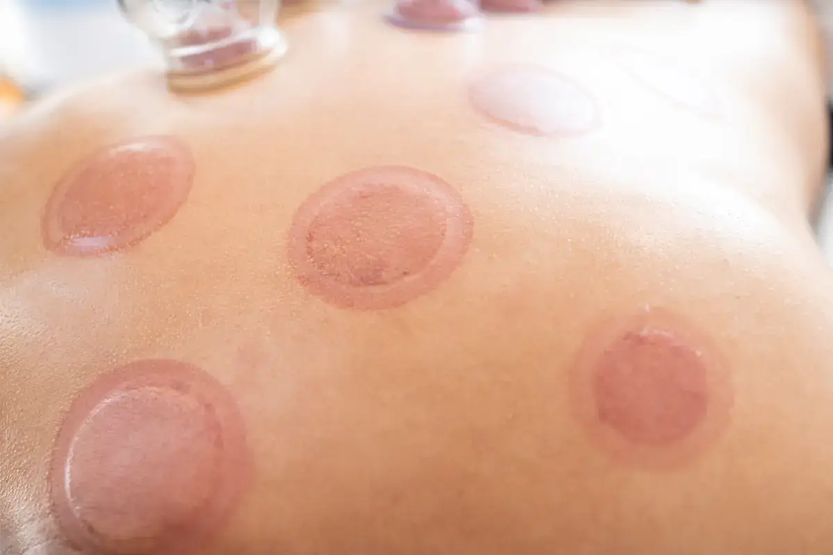 cupping therapy